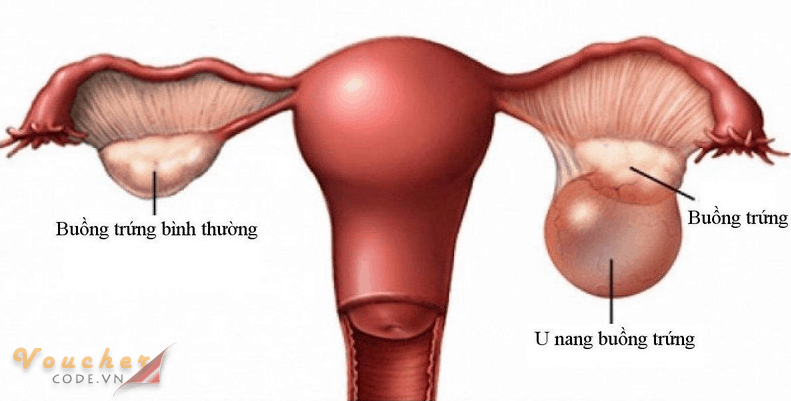 U nang khi mang thai 1 U-nang-khi-mang-thai-1