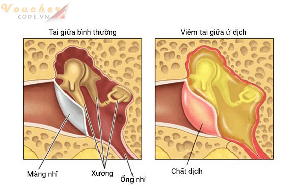 Cach chua viem tai giua bang bai thuoc dan gian 1