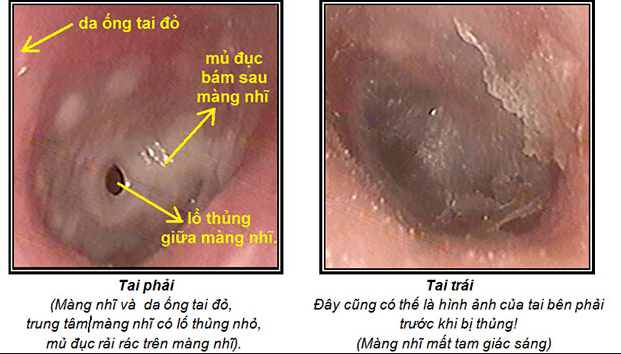 Cach chua viem tai giua bang thuoc dan gian 3