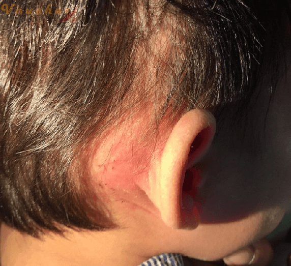 Cach chua viem tai giua bang thuoc dan gian 6