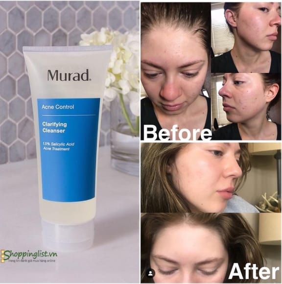 My pham Murad co tot khong 16 Kem trị mụn Murad Outsmart Acne Clarifying Treatment