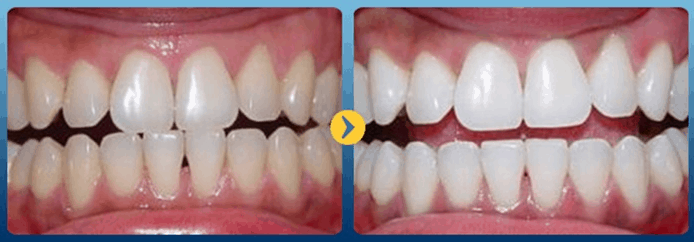 Review bot tay trang rang Eucryl co tot khong 6 Review-bot-tay-trang-rang-Eucryl-co-tot-khong-6