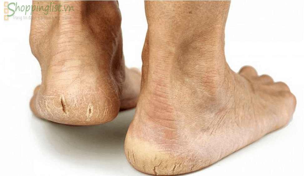 Top-10 kem-tri-nut-got-chan-hieu-qua-nhat-1