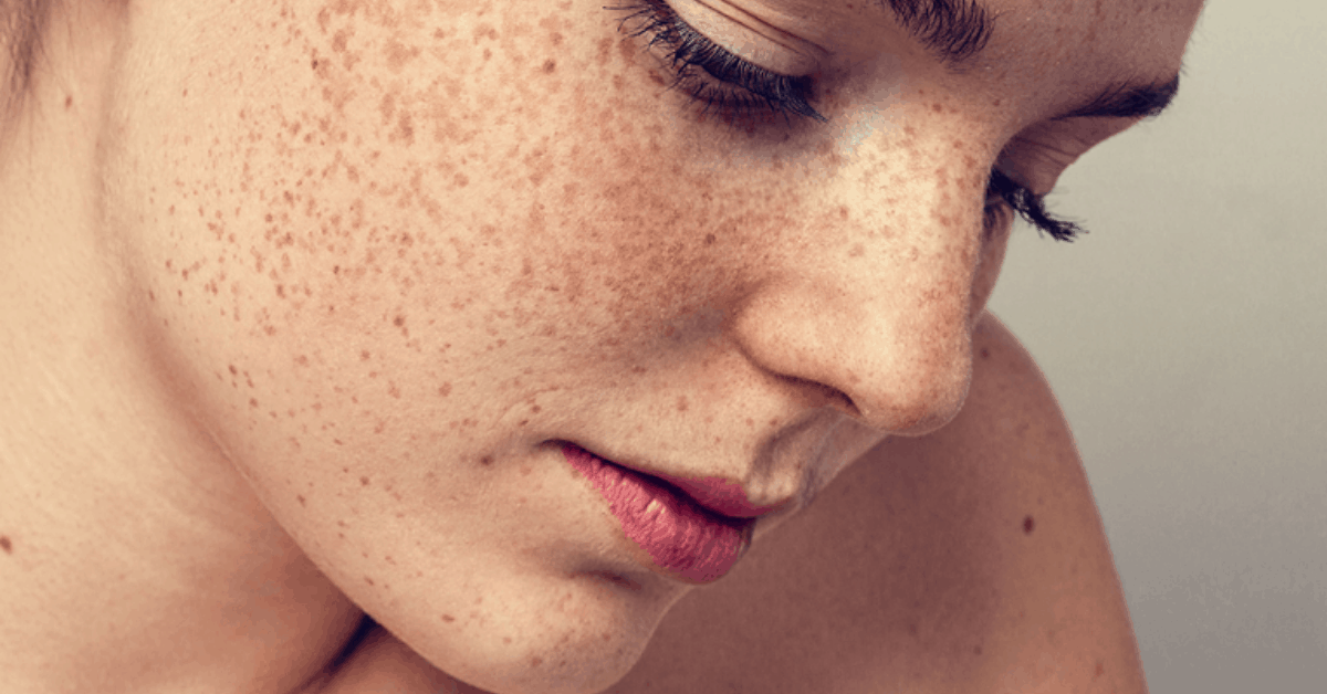 Cách trị nám da an toàn, tiêu diệt nám tận gốc