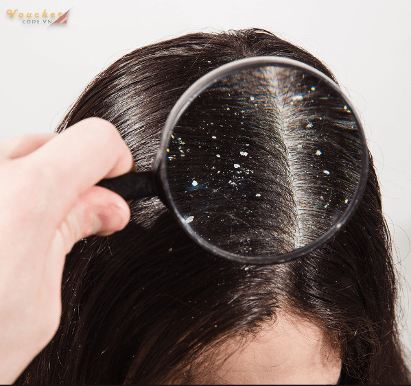 top-5-dau-goi-tri-gau-mua-dong-tot-nhat-1