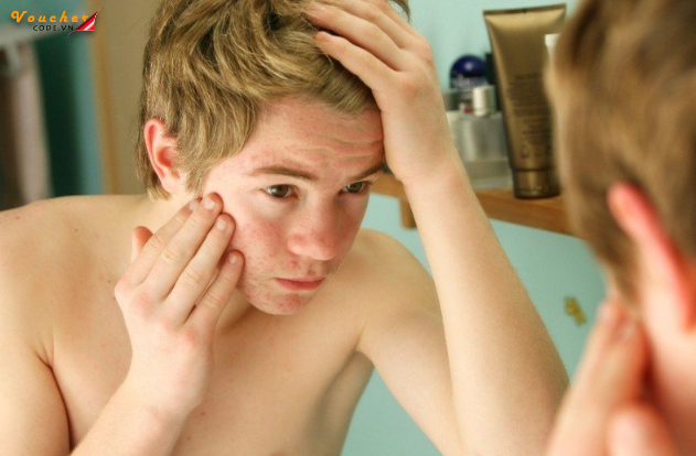 Cach Tri Mun Cho Nam Tuoi Day Thi 2