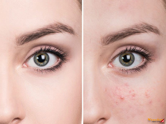 Kem Tri Mun An Tot Nhat 1