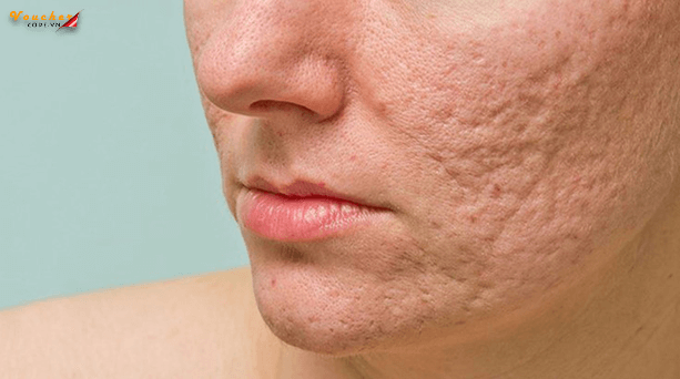 Kem Tri Seo Ro Tot Nhat 1