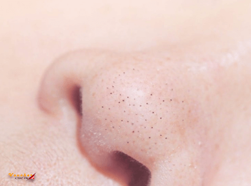 sua rua mat tri mun dau den 1