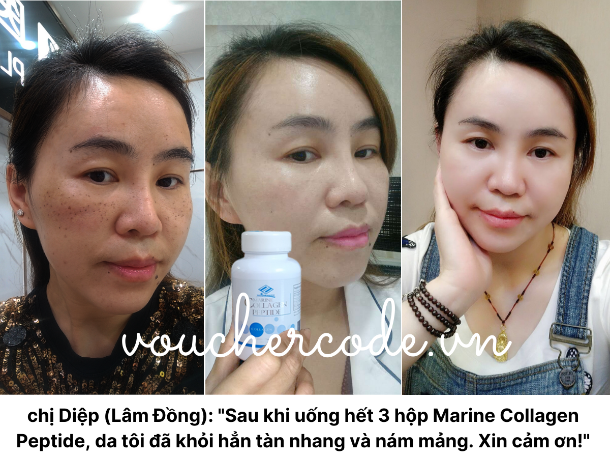 Uống Marine Collagen Peptide có khỏi nám không?