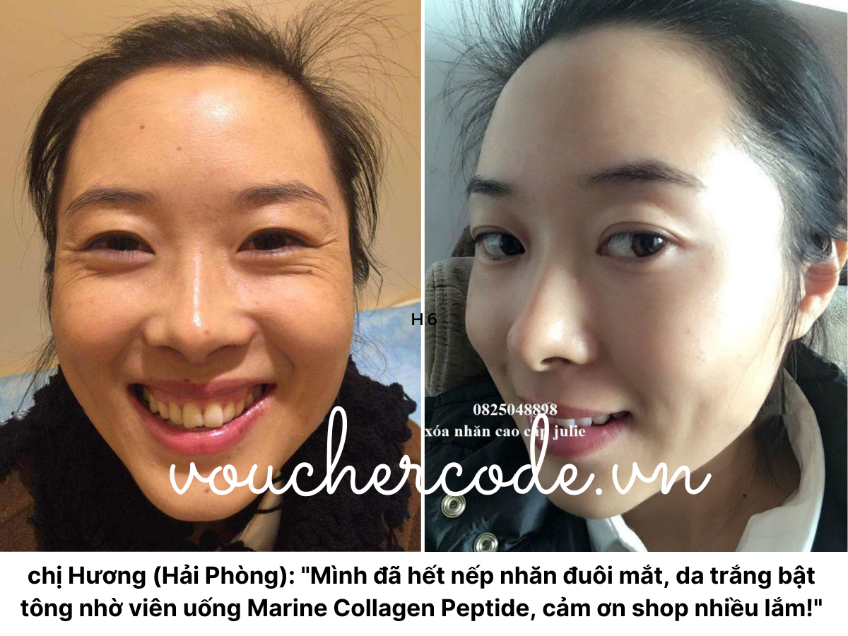 Uống Marine Collagen Peptide có hết nhăn không?
