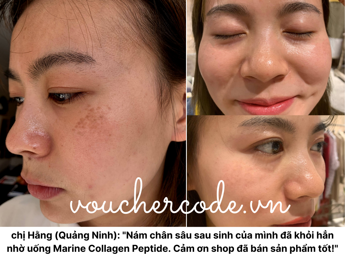 Uống Marine Collagen Peptide có khỏi nám không?